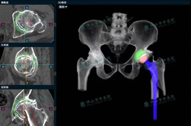 人工智能（AI）3D数字术前模拟规划