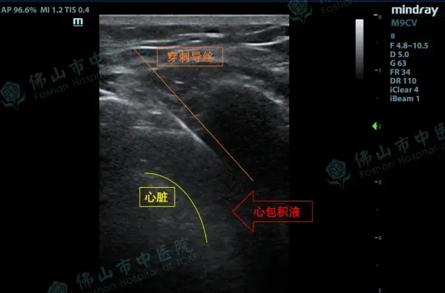超声全程直视下行心包穿刺 超声全程直视下行心包穿刺
