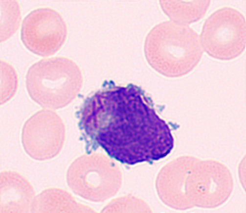 异常早幼粒细胞 异常早幼粒细胞