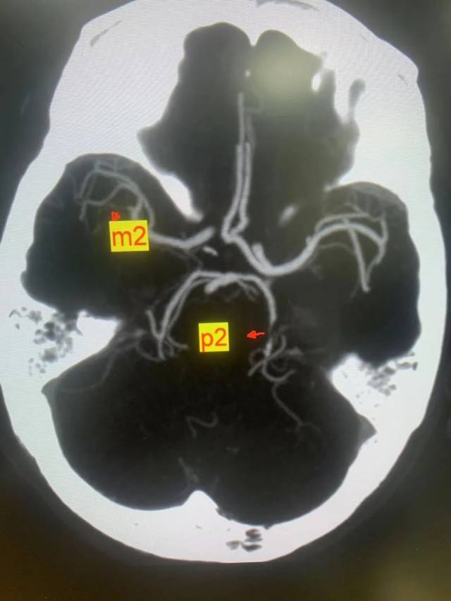 顱腦CTA腦血管狹窄處