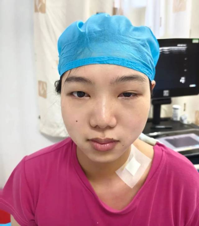 霍纳综合征
