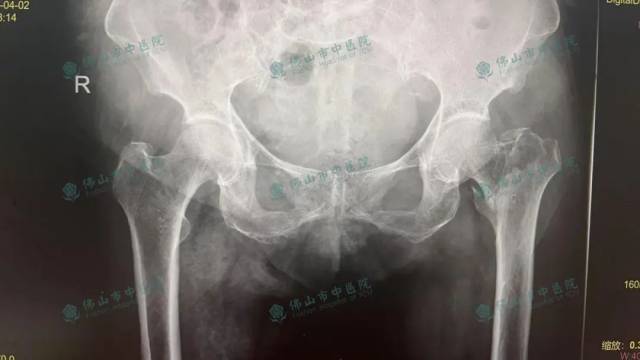 患者髋部X光影像图