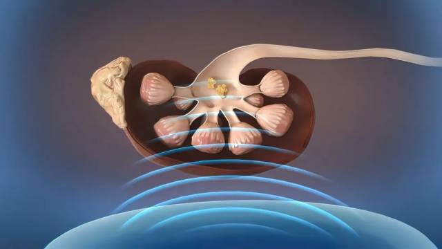 声波碎石原理图