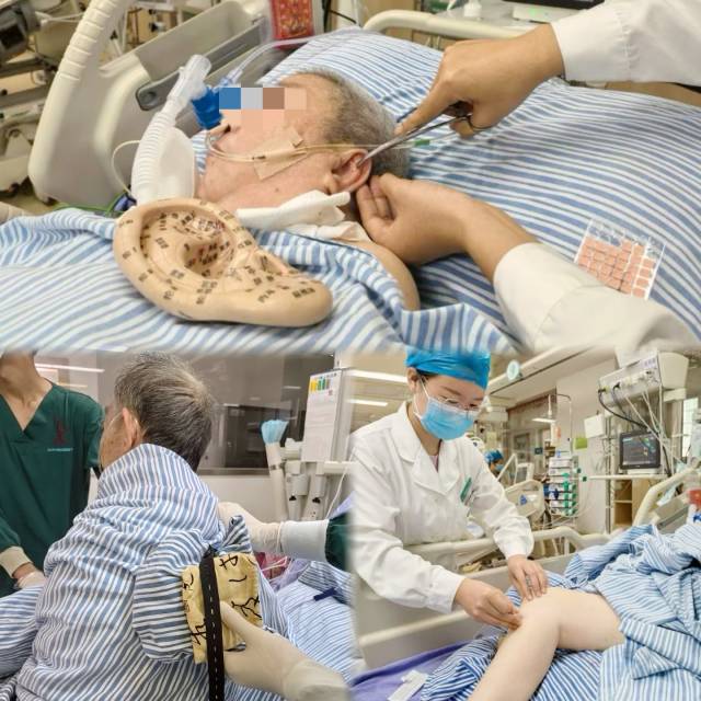 为患者行耳穴压豆、无烟艾灸和针刺治疗