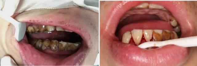 治疗前口腔状态