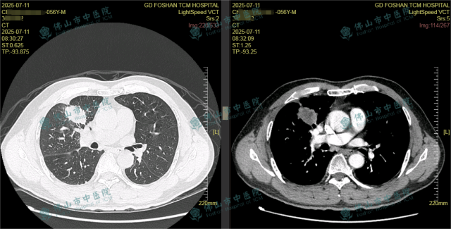 右肺上叶团块影
