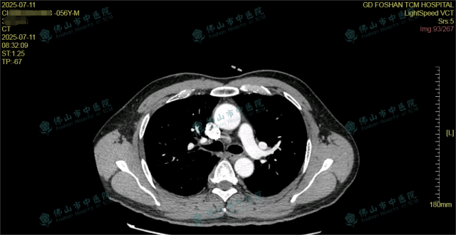 纵膈淋巴结肿大