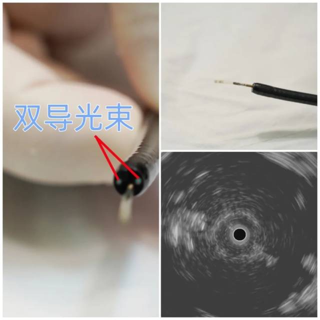 RP-EBUS，径向超声