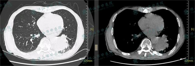 初诊胸部CT片示左肺下叶后基底段巨大肿块