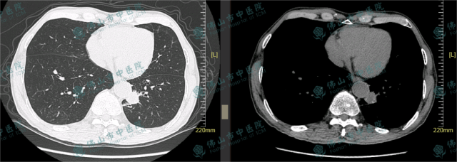 新辅助化疗及免疫治疗后左下肺肿块明显缩小