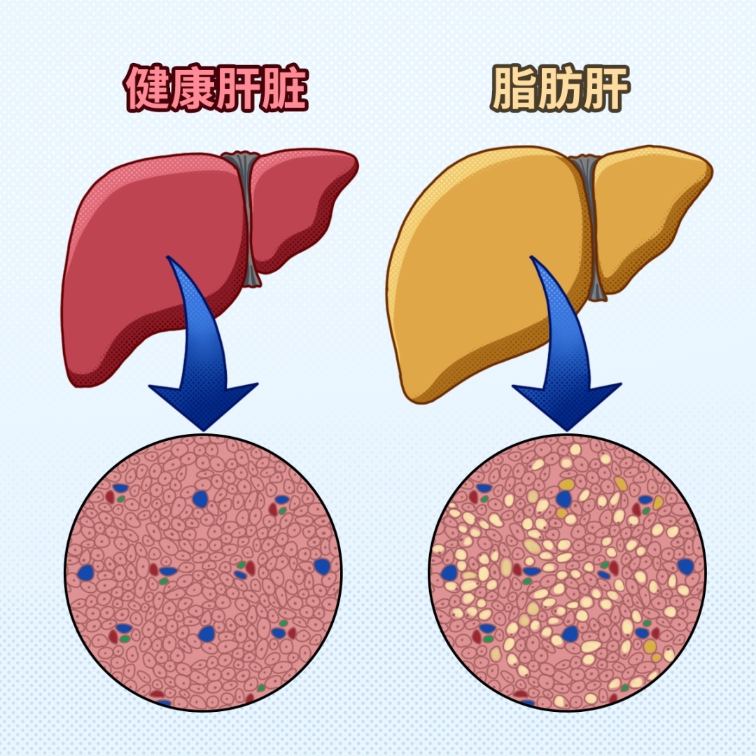 没想到吧！糖尿病和脂肪肝竟是一对“难兄难弟”……千万别让它们一起作恶！
