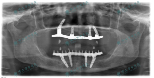 拔除全口牙种植修复缺失牙，恢复咬合功能