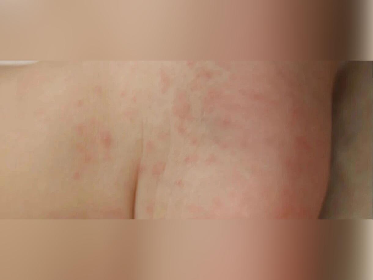 传染性强!多人确诊,官方提醒:九成都是孩子