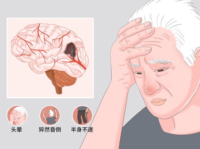 警惕 | 三高人群、熬夜族注意！脑源性猝死可能悄悄盯上你