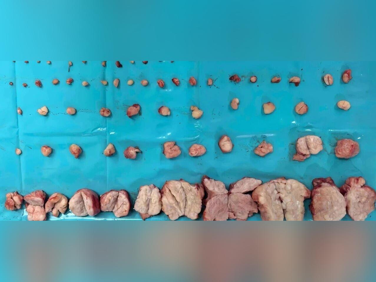 女子痛经23年,差点切除子宫,医生从她体内取出656颗瘤子