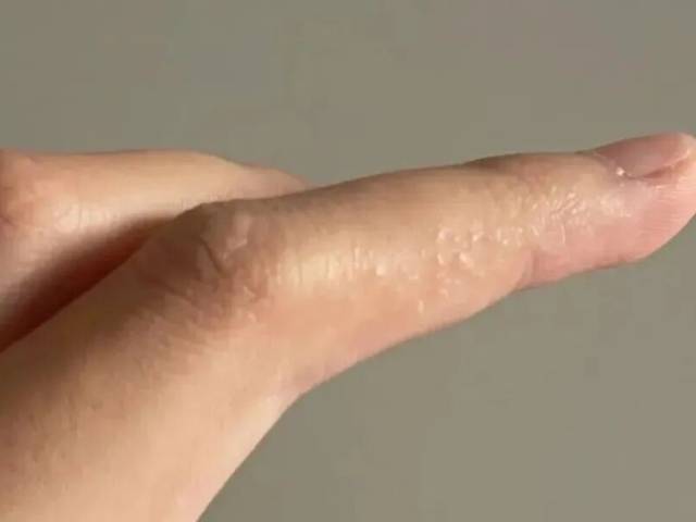 奇痒无比！这种夏天手上爱长的小水疱，到底是什么？