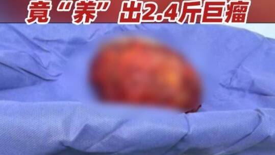 中山阿姨乳房长了个小疙瘩，盲目调理半年，“养”出2.4斤巨瘤！