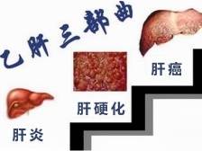怎样阻止乙肝进展成肝硬化？“双抗治疗”缺一不可