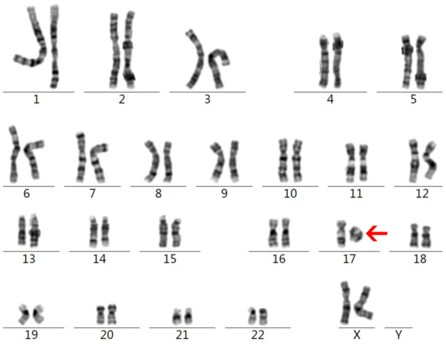 17號(hào)染色其中一條體呈現(xiàn)環(huán)形。  