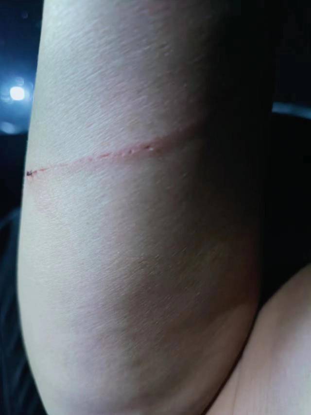 邓占荣手臂被划伤