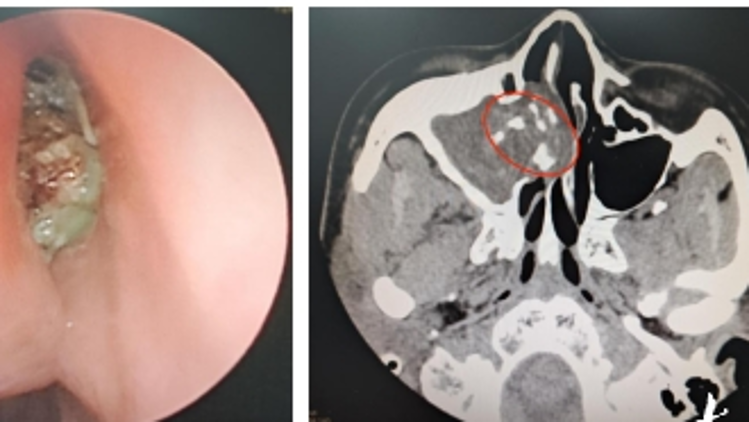 鼻子流血发臭？警惕真菌性鼻窦炎