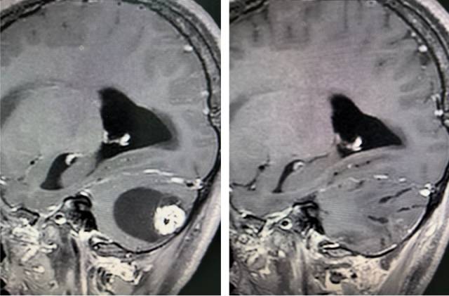 手术前后影像对比，脑肿瘤已完全切除。  受访者供图