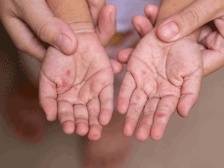 夏季这种病毒存暴发风险？网友：中不中招难道看命……｜健康深一度