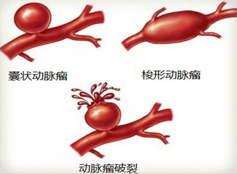 做了脑动脉瘤手术后怎么护理?
