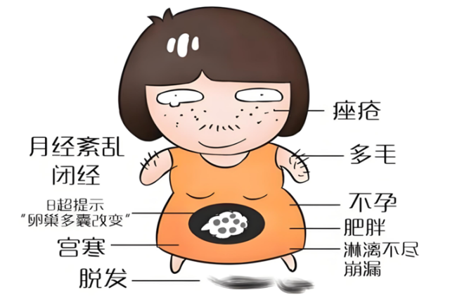 多囊卵巢综合症:生活方式改变对改善症状的重要性