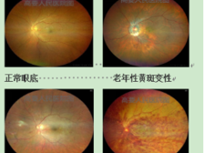视力下降、视物变形、眼前黑影……小心眼底病！