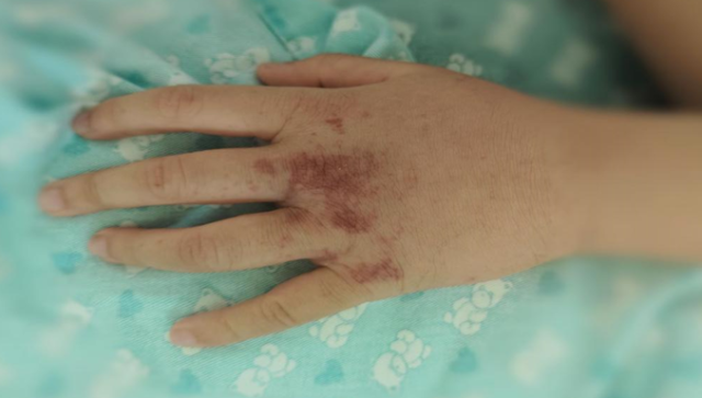 一文看懂儿童过敏性紫癜