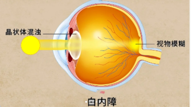 年轻人,居然也会得白内障?