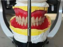 生物功能性全口义齿：无牙患者的新选择