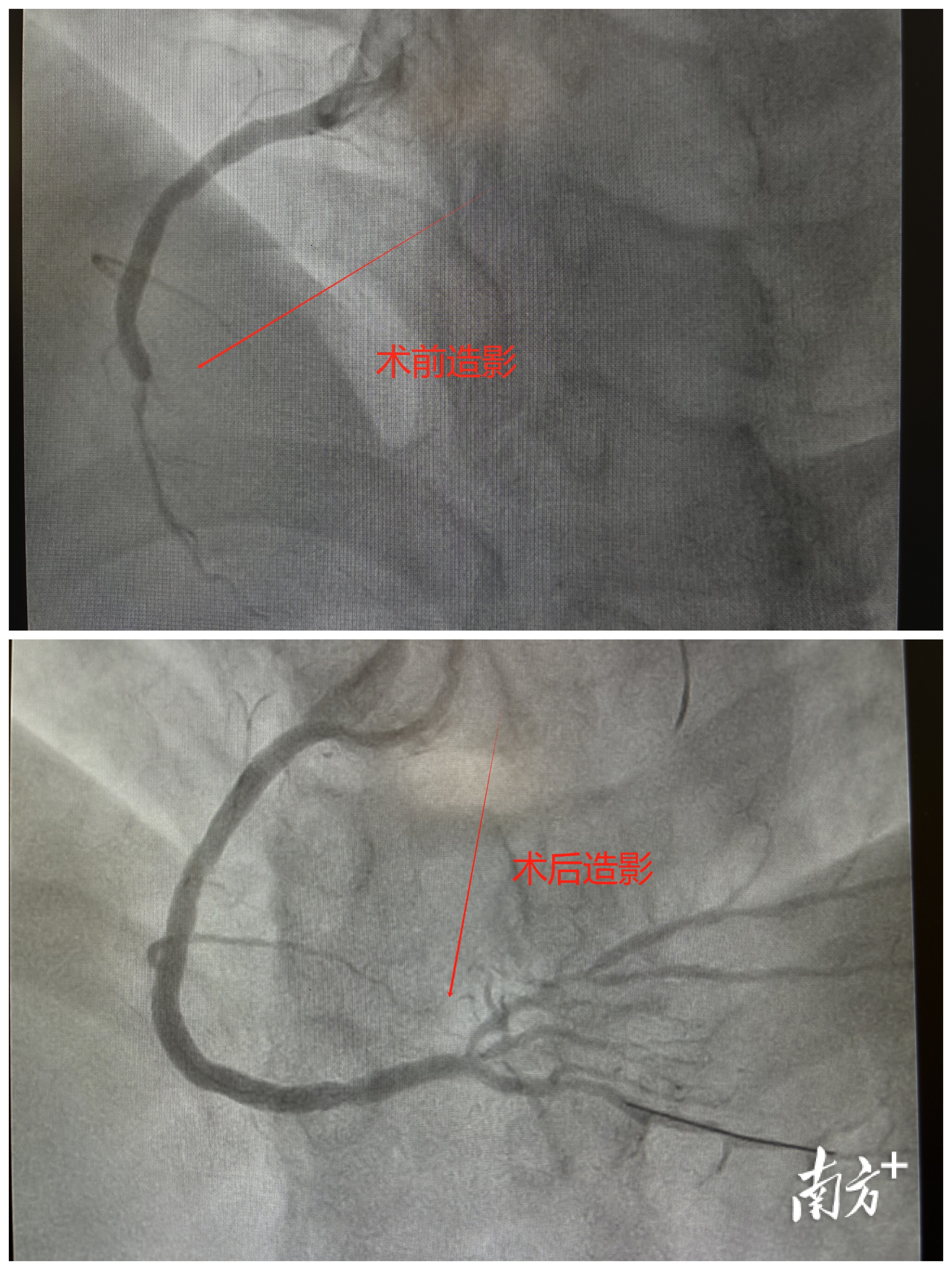 手术前后造影对比图。