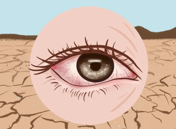 眼睛干涩?教你如何远离干眼困扰!