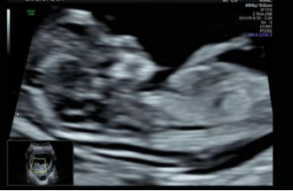 宝宝的“宫内探秘”:产科超声都能看到啥?