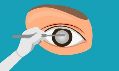 白内障手术:让“心灵之窗”重焕光明