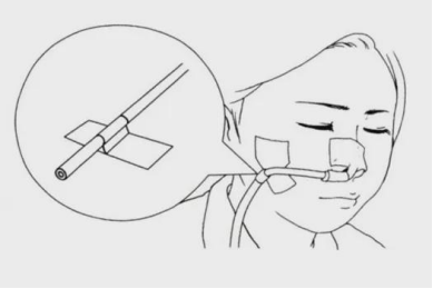 肿瘤患者如何实行家庭肠内营养?