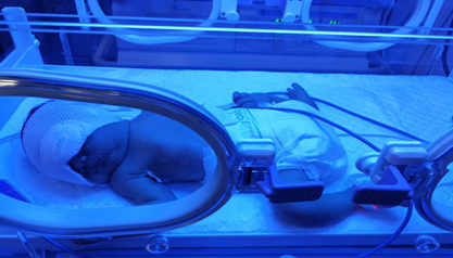 新生儿黄疸:新手父母遇到的第一个医学难题