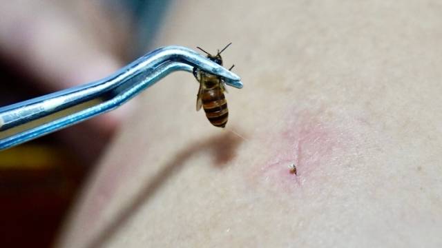 特写｜蜜蜂变身针灸师？中山传统中医的“甜蜜”创新