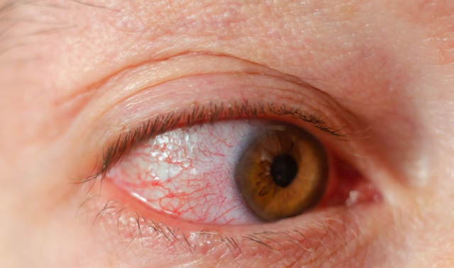 视力模糊像打了“马赛克”?可能是糖尿病在“搞事情”!