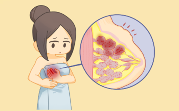 轻松识别“胸”险信号,做自己的乳腺小卫士!