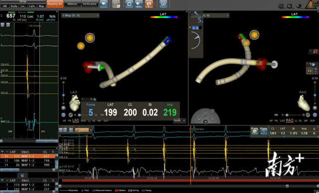 室上速射频消融图。资料图 室上速射频消融图。资料图