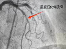 心脏血管长了 “硬石头”？“磨”“震” 联手打通生命通道