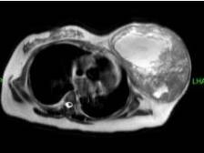 中山市人民医院多学科协作，为患者卸下2.1公斤肿瘤