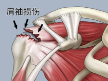 肩膀痛到“抬不起手”？别硬扛，康复有妙招！