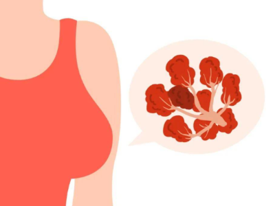 乳腺结节别惊慌，一文读懂早预防