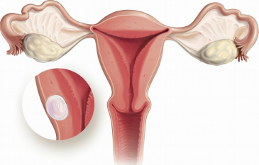 内膜病变“搞偷袭”,女性健康红灯亮起