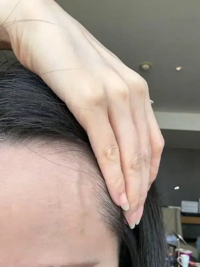 张靓颖额头的血管突起