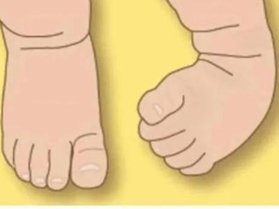 “马蹄足”宝贝可以运动吗？